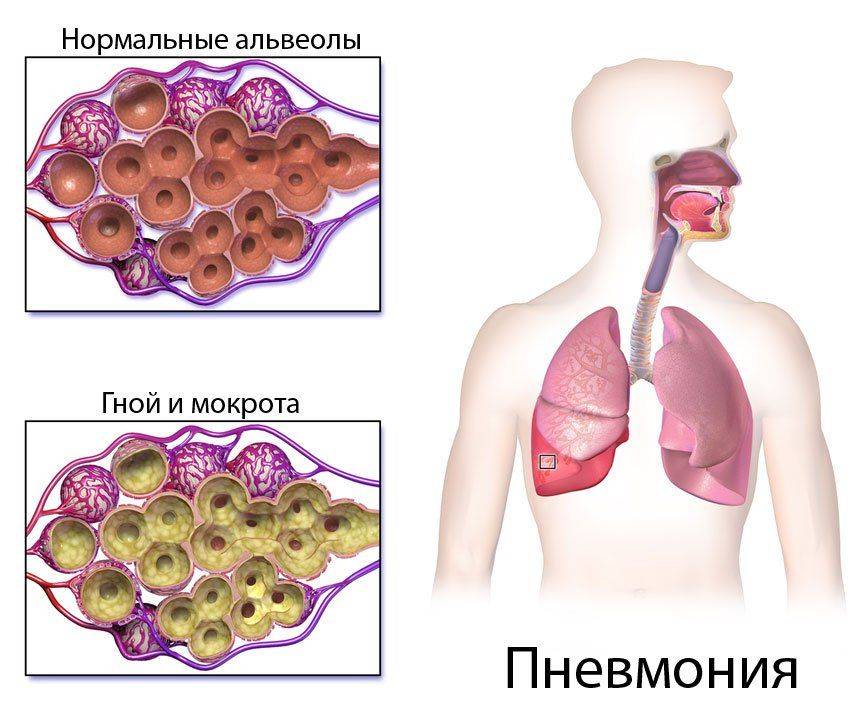 Заболевание бронхит и туберкулез thumbnail