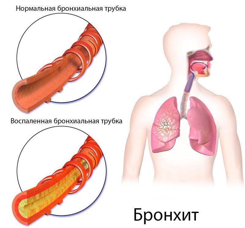 Бронхит и туберкулез синдромы thumbnail