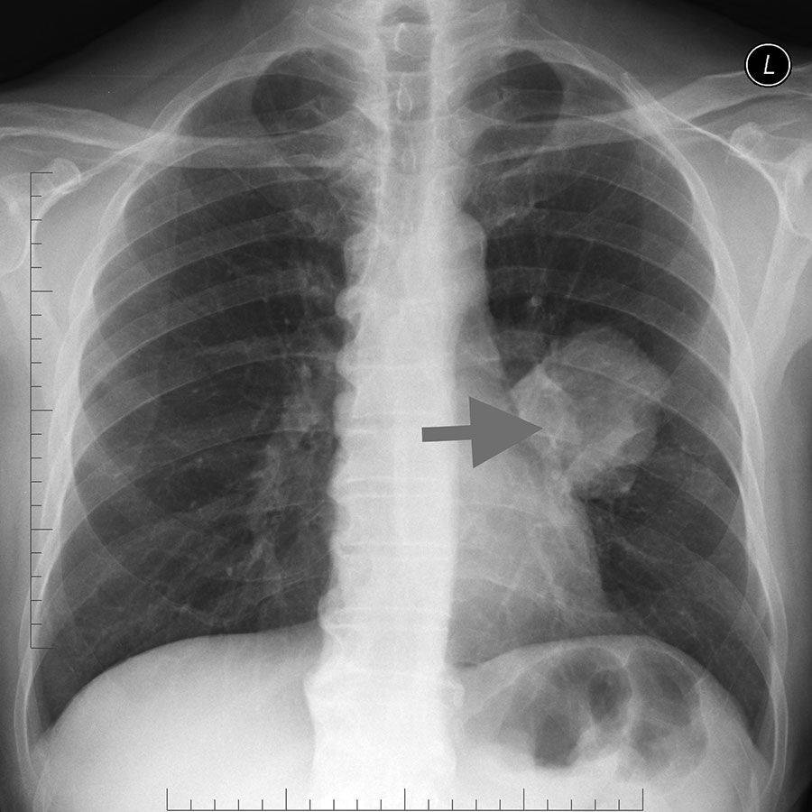 Очаговый туберкулез рентген