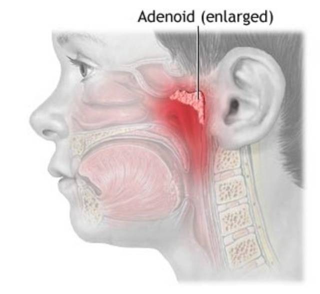 Аденоиды у детей: фото, симптомы и лечение, операция по удалению, как вылечить без операции