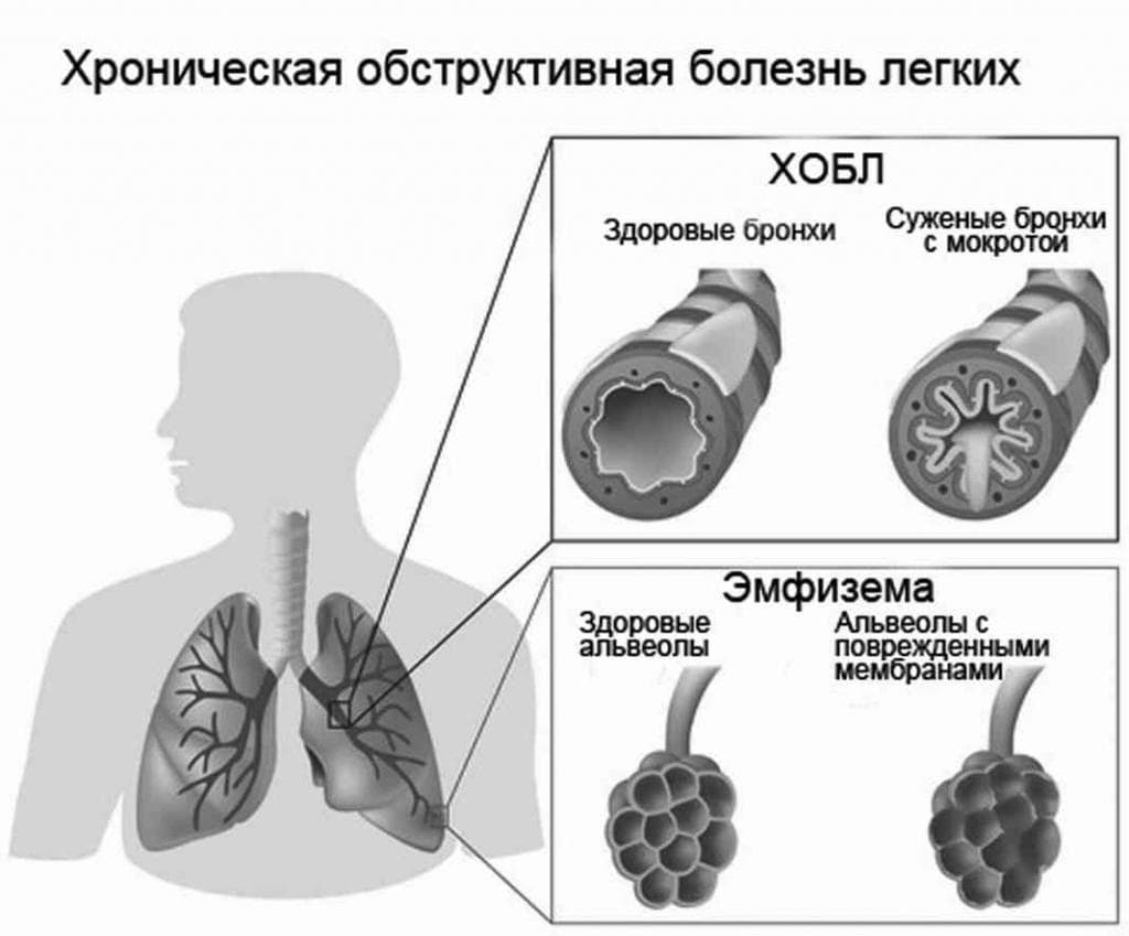 Лечение хобл (хронической обструктивной болезни лёгких) народными средствами