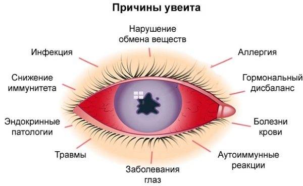 Заболевание глаз увеит: причины, симптомы и лечение - sammedic.ru