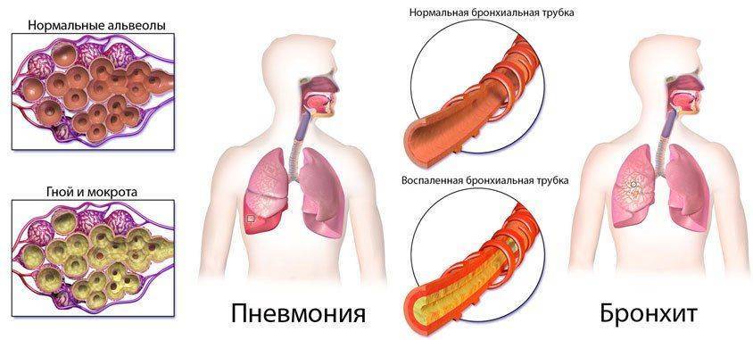 Как отличить бронхит от пневмонии и чем они отличаются? | prof-medstail.ru