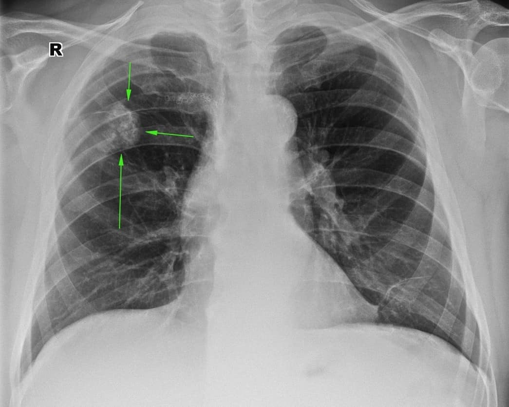 Очаговый туберкулез легких: причины, симптомы и лечение