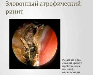 Хроническое заболевание полости носа характеризующееся атрофией слизистой - wikilechenie.ru