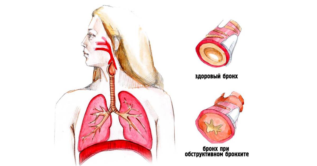 Симптомы и принципы лечения бронхиальной астмы у взрослых