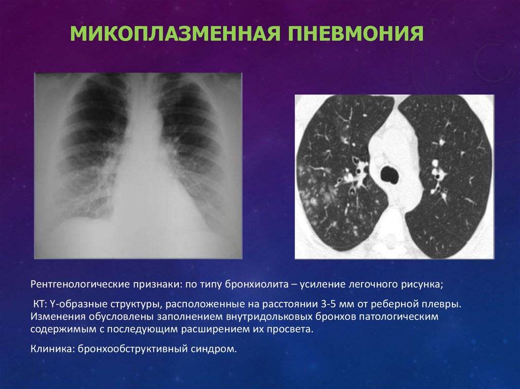 Левосторонняя пневмония – причины, симптомы, лечение