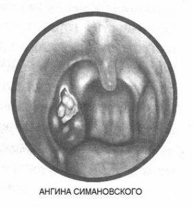 Ангина симановского-венсана: причины развития язвенно-пленчатой ангины, лечение ангины плаута-венсана