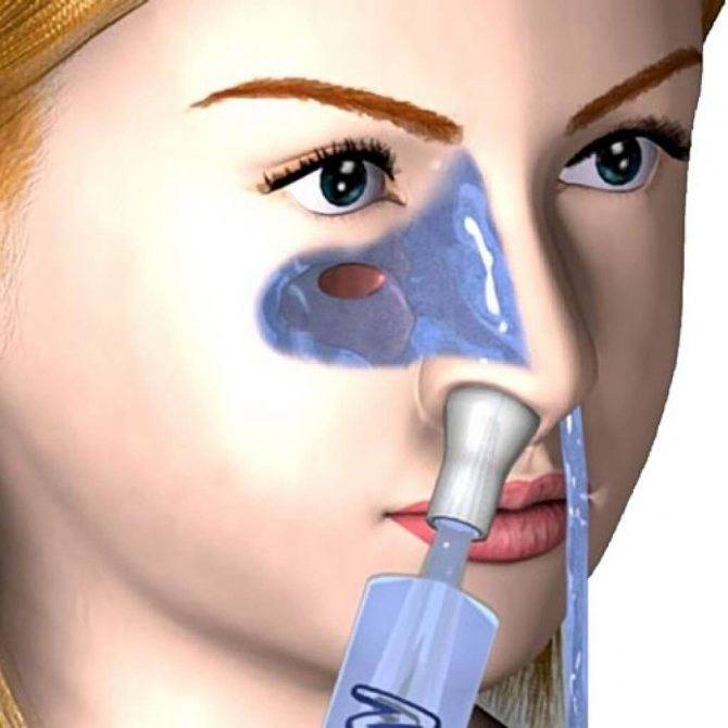 Правила и особенности промывания носа при насморке