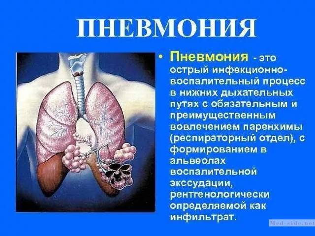 Вирусная пневмония - особенности заболевания