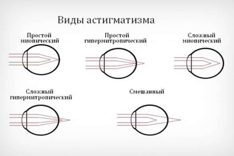 Миопический астигматизм - сложная и простая форма обоих или одного глаза