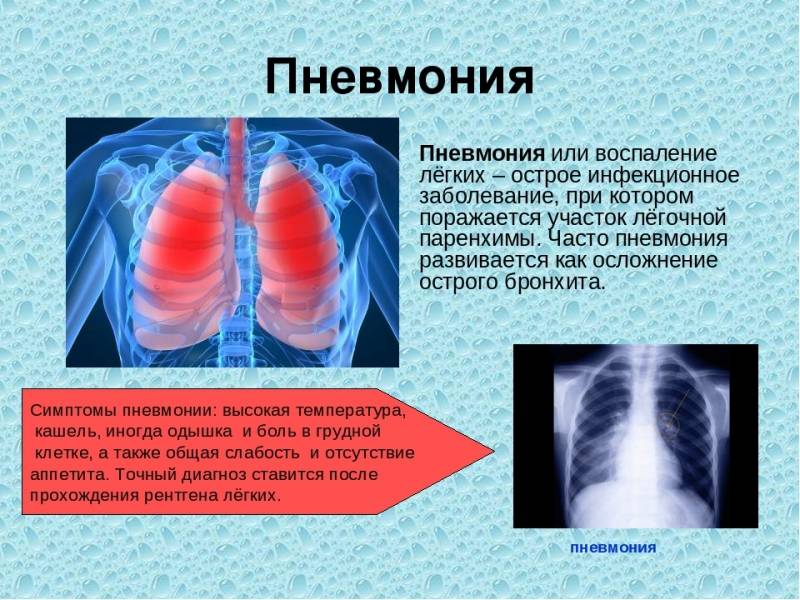 Как вылечить затяжной кашель после пневмонии