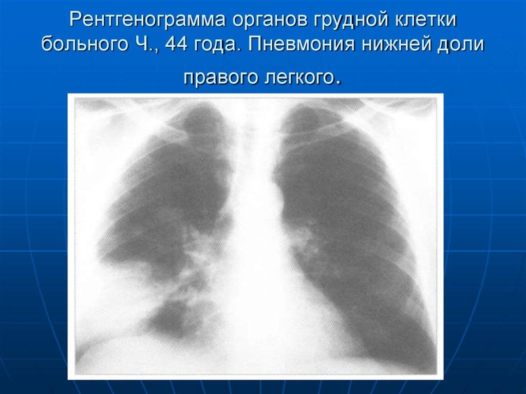 Двусторонняя нижнедолевая пневмония - все о простуде и лор-заболеваниях