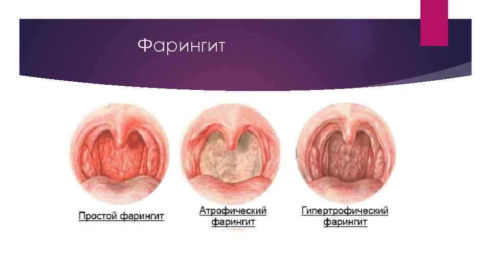 Фарингит - симптомы | компетентно о здоровье на ilive