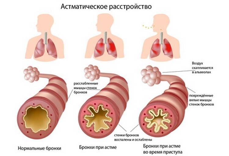 Лечение бронхиальной астмы у взрослых. можно ли вылечить и как?