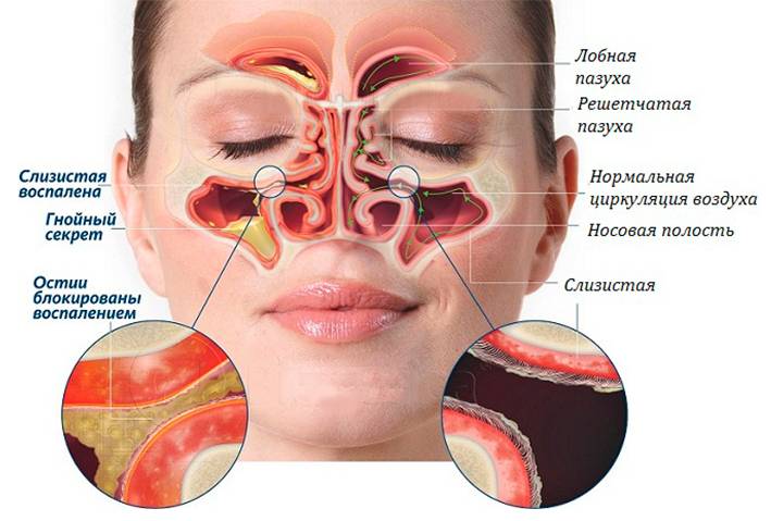 Болят пазухи носа без насморка: что делать и как лечить?
