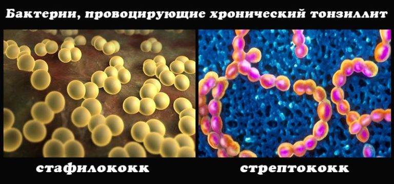 Streptococcus и гриб candida. а также дисбактериоз верхних дыхательных путей