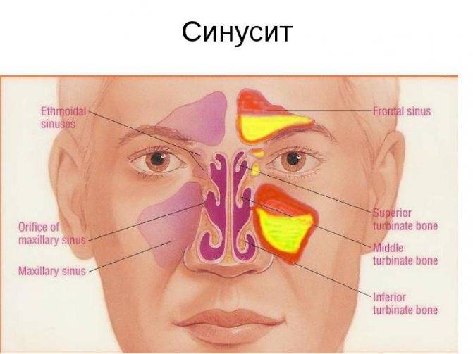 Лечение воспаления слизистой оболочки носа