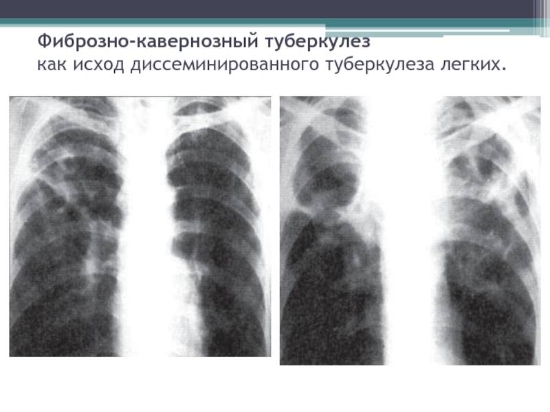Туберкулез легких – код по мкб-10 у взрослых: инфильтративный, диссеминированный