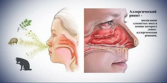 Заложенность носа с соплями лечение народными средствами