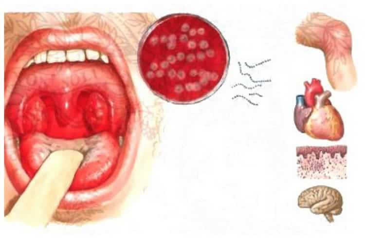 Стрептококк в горле: симптомы и лечение у взрослых пациентов