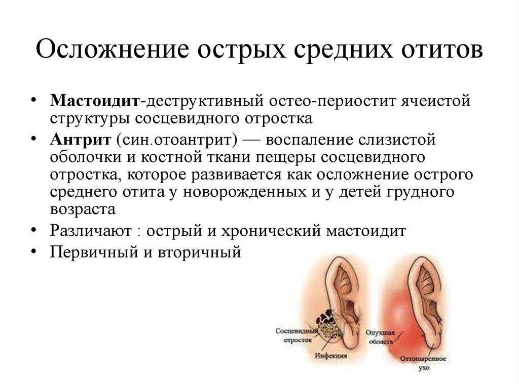Лечение острого отита среднего уха у детей симптомы и лечение