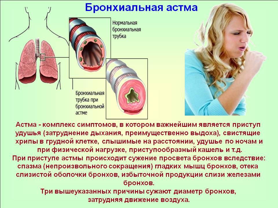 Симптомы бронхиальной астмы у детей, особенности лечения и профилактика
