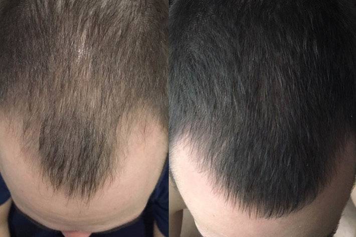 Алопеция — лечение, профилактика выпадения волос средствами alerana