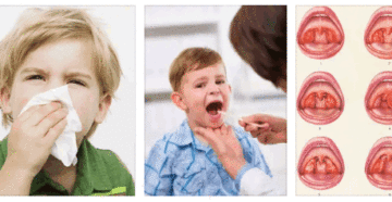 Воспаление аденоидов у ребенка: симптомы, лечение и причины аденоидита у детей