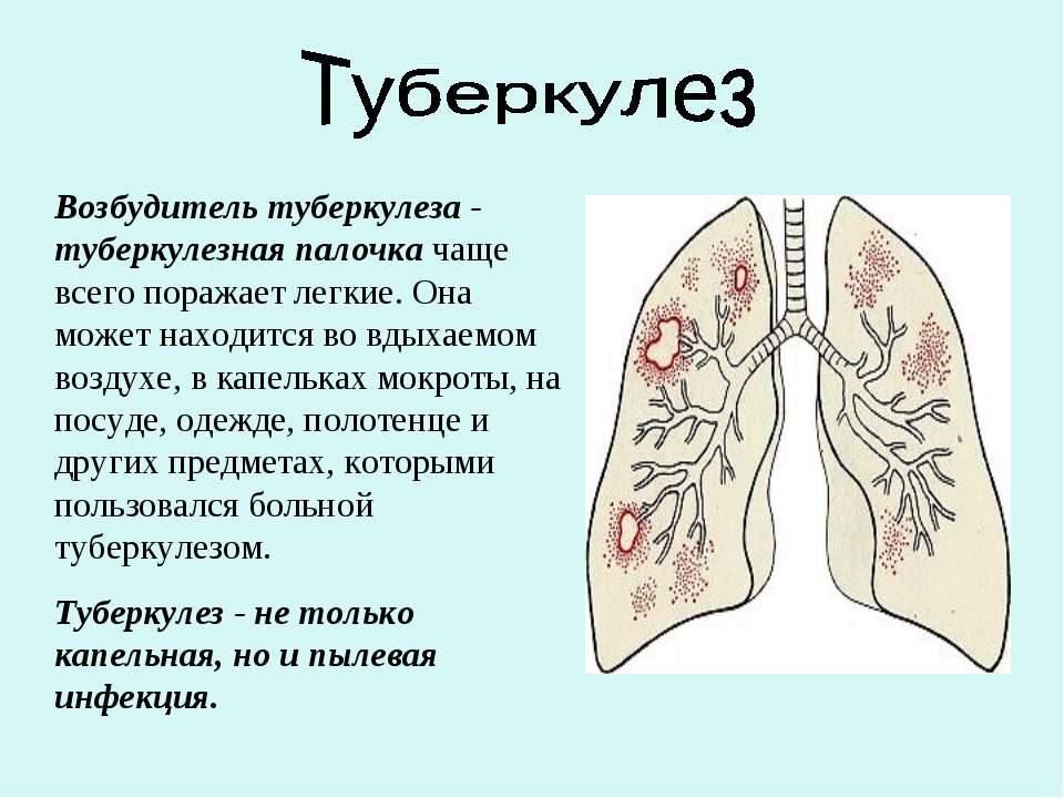 Виды туберкулеза легких: особенности и характеристики