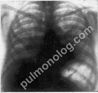 Очаговый туберкулез легких - дифференциальная диагностика
