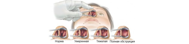 Искривление носовой перегородки – симптомы, признаки, диагностика, причины.  лечение искривления: показания, противопоказания к операции