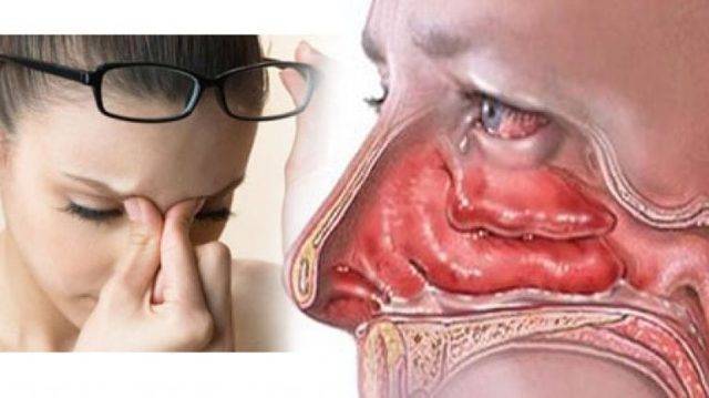 Чем безопасно вылечить заложенность носа при беременности