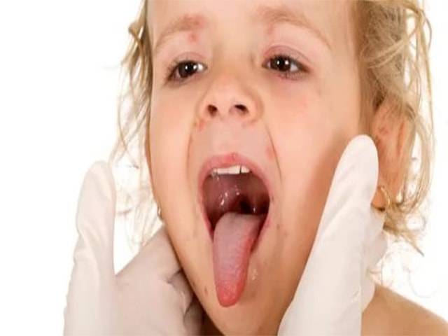 Сколько длится ангина у детей: характеристика заболеваний и правильное лечение