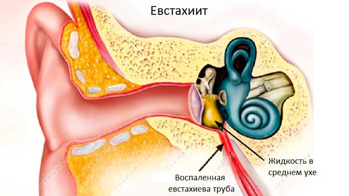 Что делать, если заложило ухо при насморке – как лечить заложенность