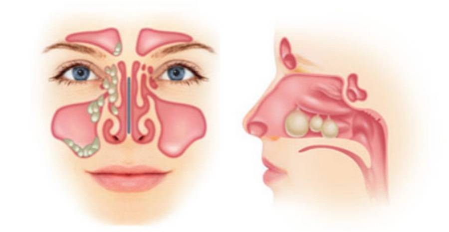 Эффективное лечение полипов в носу без операции: лекарства и домашние рецепты
