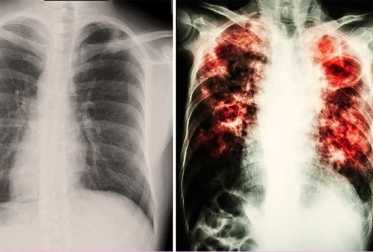Отличия открытой и закрытой формы туберкулеза — стоптубик