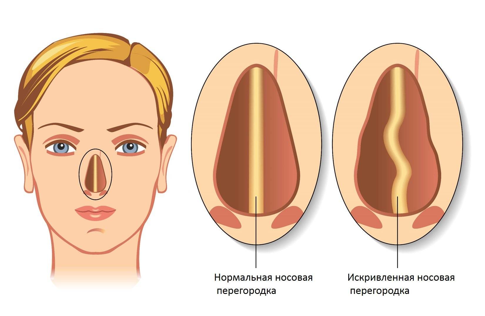 Искривление носовой перегородки: лечение без операции