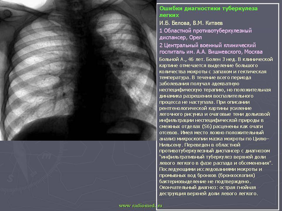 Туберкулез лёгких код мкб 10