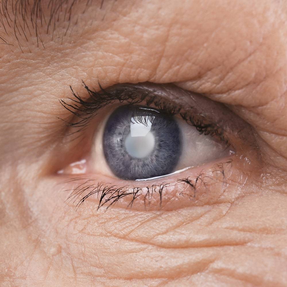 13 народных рецептов для лечения катаракты в домашних условиях