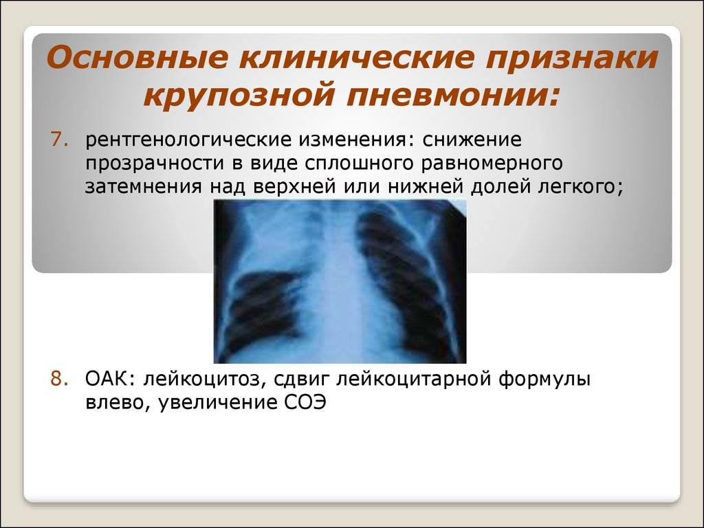 Пневмония у детей: причины, симптомы и лечение | wmj.ru