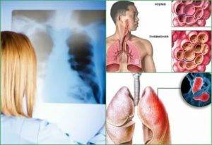Особенности параканкрозной пневмонии