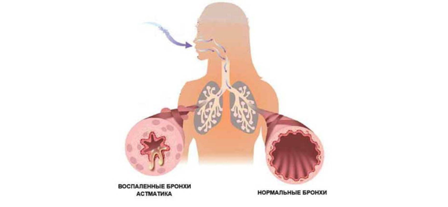 Код бронхиальной астмы по мкб 10: описание и особенности