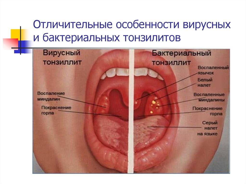 Тонзиллит - мкб-10 код, острая ангина, тонзиллофарингит гнойный, паратонзиллит, ганглионит, заболевание гортани, гипертрофия небных миндалин