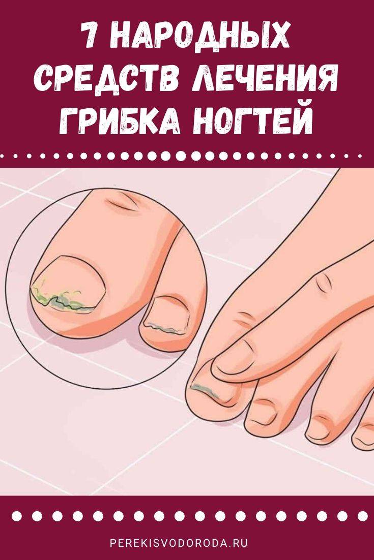 Как быстро вылечить грибок ногтей на ногах народными средствами