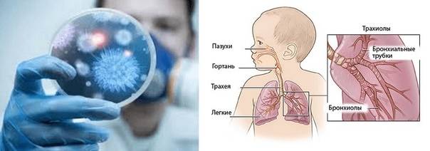 Пневмония у детей: симптомы с температурой и без температуры