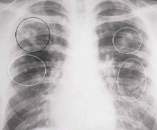 Как понять, что у тебя туберкулез легких – как выявить в домашних условиях