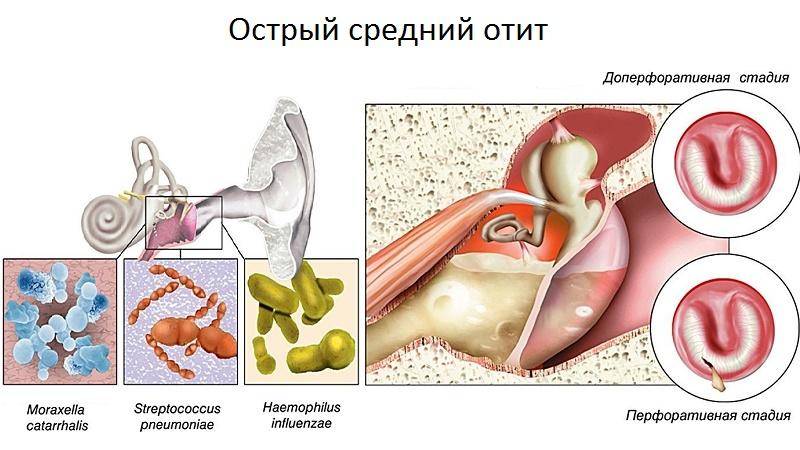 Отит среднего уха: симптомы и лечение у взрослых, антибиотики, хронический, острый, у детей