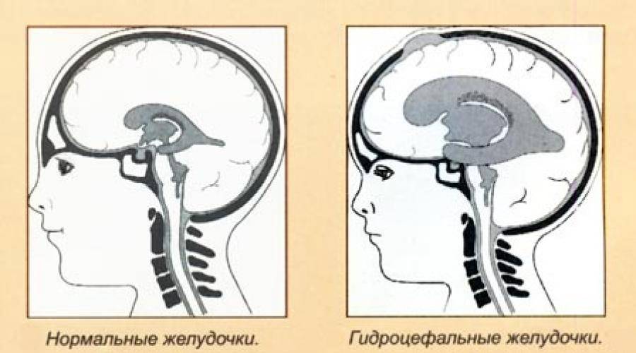 Заместительная гидроцефалия головного мозга у взрослых симптомы и лечение