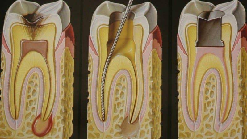 Ампутация и удаление пульпы зуба